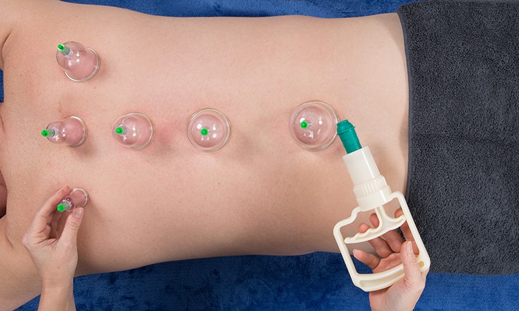 Cupping 